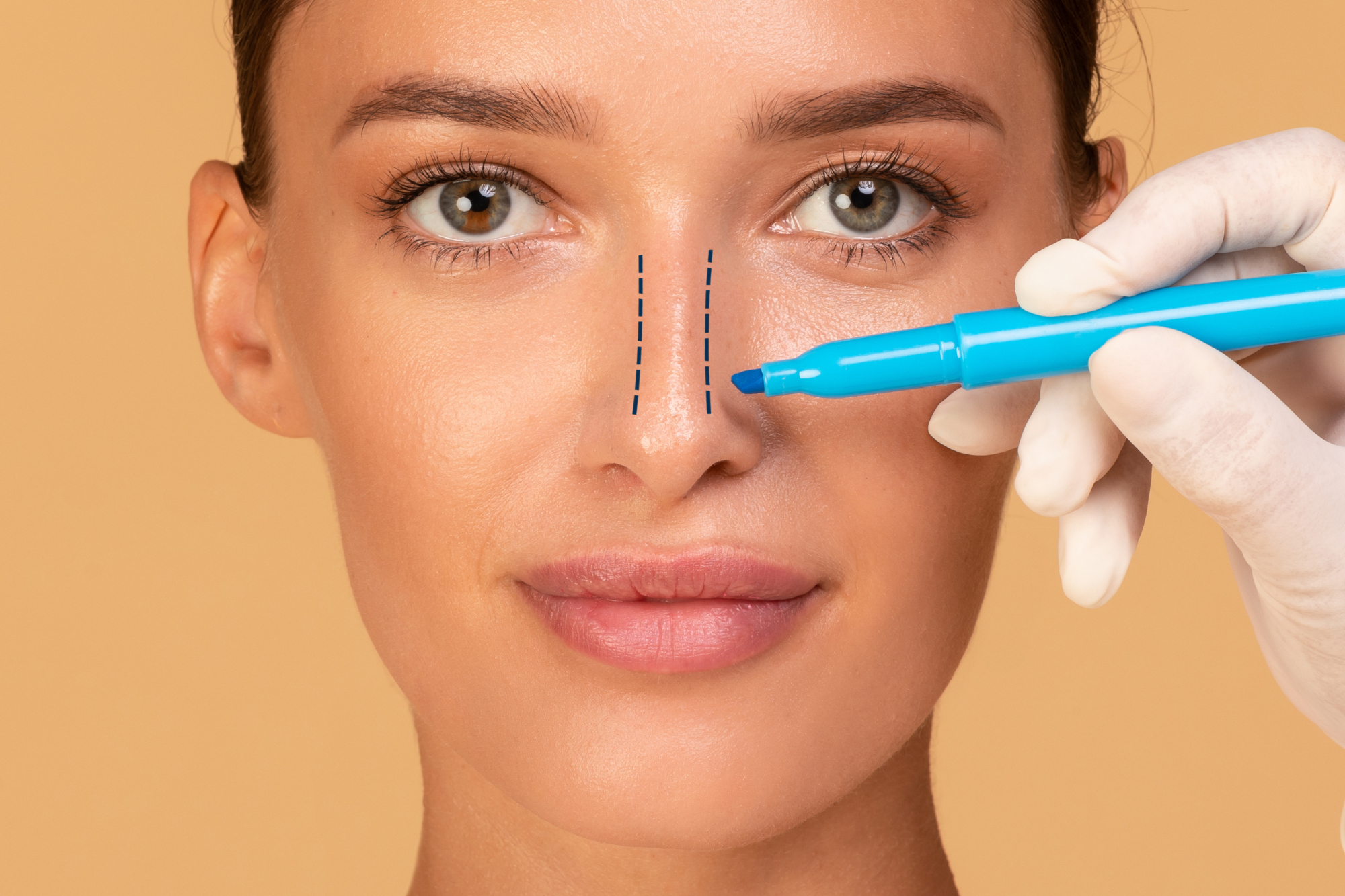 Sve što trebate znati o rinoplastici